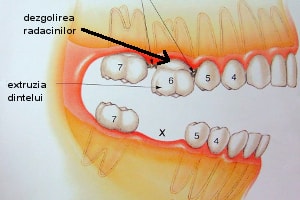 extruzia dintelui cu dezgolirea radacinilor
