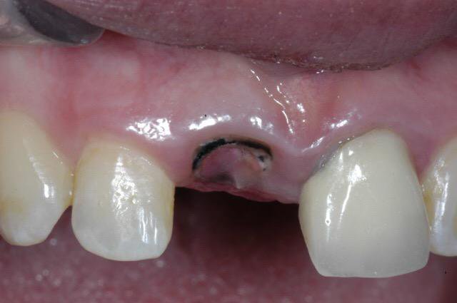 contraindicatie pivot dentar : dinte fracturat sub nivelul gingiei