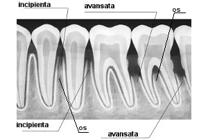 puntea dentara : rezorbtia osoasa ca conditie pentru alegerea dintilor stalpi