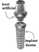 implant dentar, bont artificial
