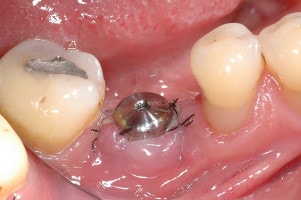 implant dentar: aplicarea capei de vindecare