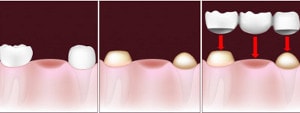 implant dentar comparat cu punte dentara