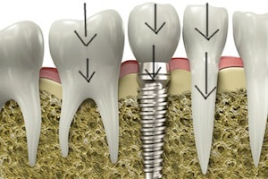 implant dentar, directia fortelor masticatorii