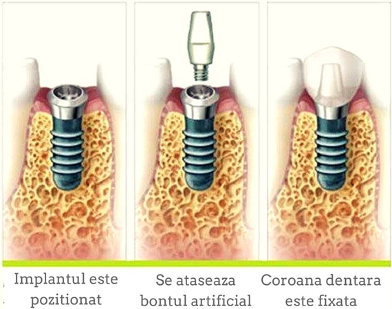 etapele realizarii unei coroane pe implant dentar