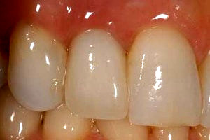 implant dentar intr-o zi