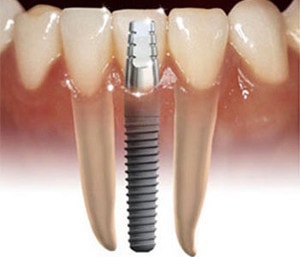 implant dentar schematic