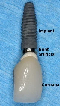 implant dentar structura generala
