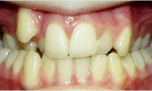 inghesuire dentara pe arcada superioara