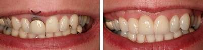 indicatie pentru punte dentara : inlocuirea lucrarilor vechi, necorespunzatoare