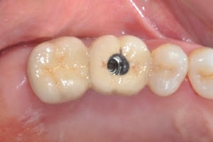 lucrare pe implanturi dentare fixata prin infiletare