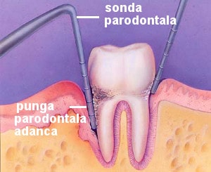 paradontoza : masurarea pungilor parodontale