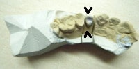 modelul de gips - partea cu dintii slefuiti