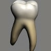 puntea dentara, alegerea dintilor stalpi : primul molar inferior