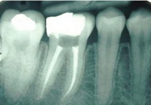 indicatie pivot dentar : obturatie radiculara corecta