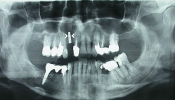 implant dentar riscuri: penetrarea sinusului maxilar