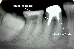 pivot dentar cu 2 pivoti radiculari