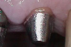 pivot dentar dupa slefuire