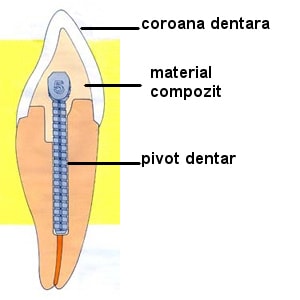pivot dentar prefabricat fixat prin insurubare pe canalul radicular