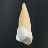 puntea dentara, alegerea dintilor stalpi : al doilea premolar superior