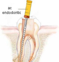 tratament endodontic: prepararea canalelor radiculare