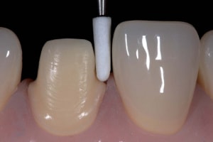 lucrari dentare : prepararea dintilor prin slefuire