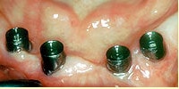 proteza pe implanturi dentare: probele scheletului metalic faza 1