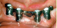 proteza pe implanturi dentare: probele scheletului metalic faza 2