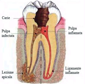 progresia infectiei in interiorul dintelui
