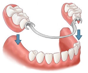 proteza dentara partiala