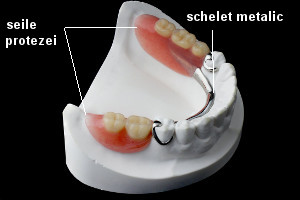 proteza dentara partiala pe modelul de gips