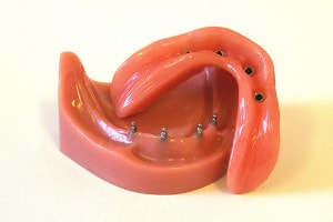 proteza mobilizabila pe implanturi dentare