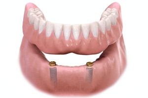 proteza mobilizabila pe implanturi dentare