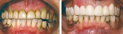 indicatie pentru punte dentara : dinti cu modificari de culoare si obturatii inestetice
