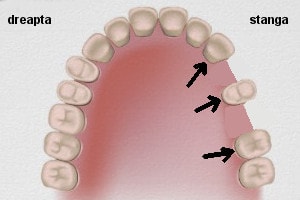 puntea dentara, exemple practice : cazul 2 solutia 1