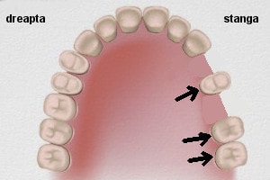puntea dentara, exemple practice : cazul 2 solutia 2