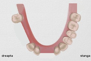 puntea dentara, exemple practice : cazul 3