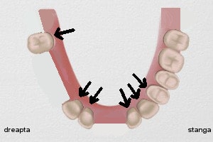 puntea dentara, exemple practice : cazul 3 solutia