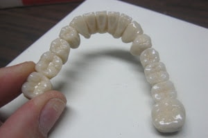 puntea dentara totala