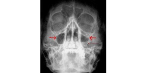 radiografie dentara de sinus