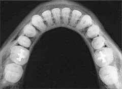 radiografie dentara ocluzala
