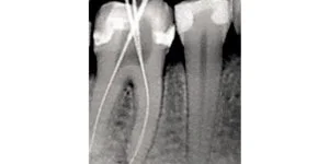 radiografie dentara retro-alveolara