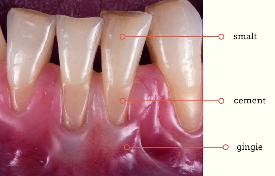 retractie gingivala cu dezgolirea zonelor de cement dentar
