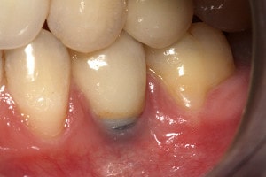 complicatii implant dentar: retractia gingivala