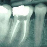 dinte cu obturatie de canal corecta : indicat ca stalp de punte dentara
