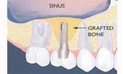 sinus lifting pentru implanturi dentare dupa de operatie