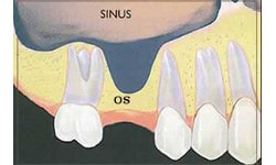 sinus lifting pentru implanturi dentare inainte de operatie