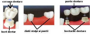 slefuirea dintilor pentru coroana dentara respectiv punte dentara