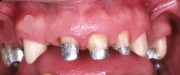 slefuirea dintilor pentru o punte dentara