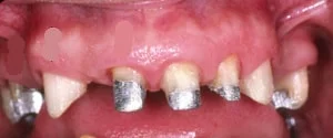 slefuirea dintilor pentru o punte dentara