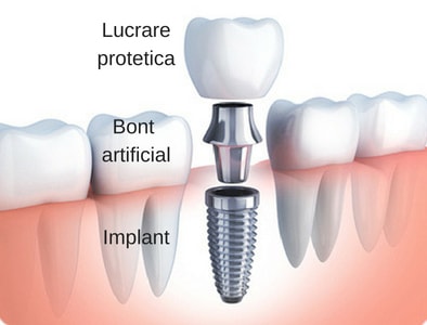 structura implant dentar